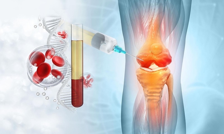 PRP &ndash; Plasma Ricco di Piastrine